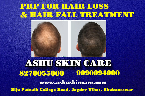 prp for hair loss and hair fall treatment clinic in bhubaneswar near me